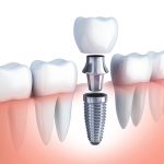 Trồng răng implant bao lâu thì ăn được? Nên ăn gì và kiêng gì?