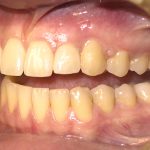 Giải đáp: Thực hiện tẩy trắng răng có bị vàng lại không?