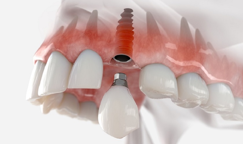 doi tuong trong implant 1 vai lan