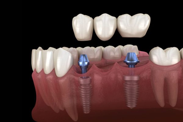 thuc hien gan mao su implant