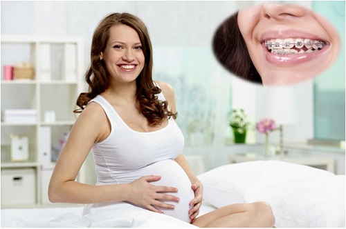 Niềng răng khi trong thời kỳ mang thai