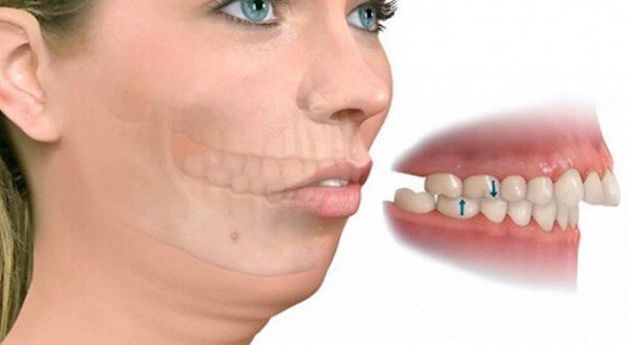 Niềng răng hô ở hàm trên có được không? Chi phí bao nhiêu?