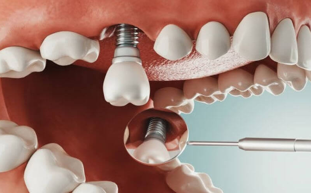 uu diem trong rang implant 1 vai lan