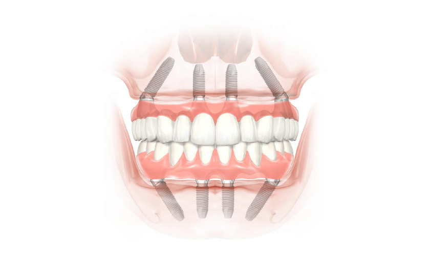 trong rang implant tuc thi