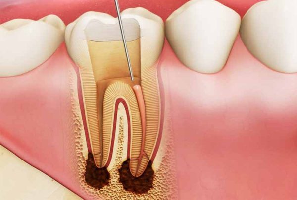 Làm thế nào để có thể giảm thiểu tình áp xe răng