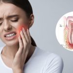 Áp xe răng khôn được hiểu như thế nào?