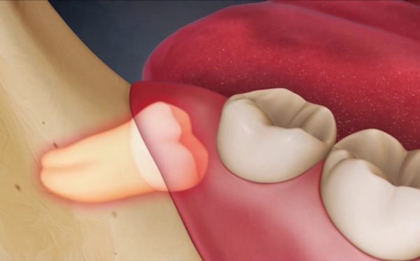Áp xe răng khôn được hiểu như thế nào?