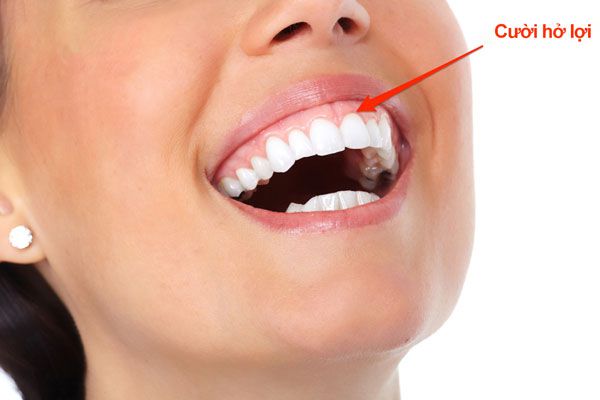 Ý nghĩa tướng số của những người cười hở lợi?