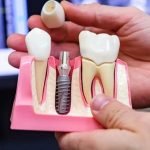 Nên trồng răng bằng cầu răng hay cấy ghép implant