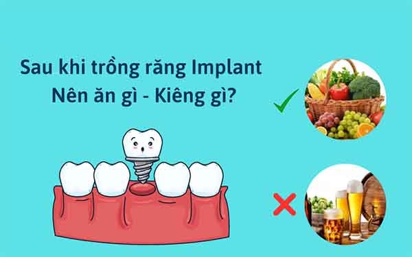 trong rang implant kieng an gi