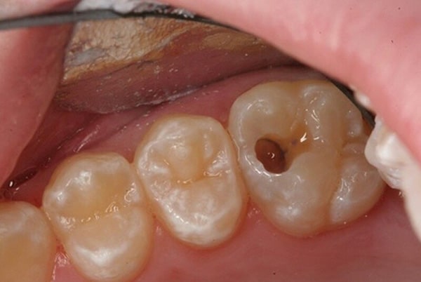 Bị sâu răng nhẹ đánh răng có hết được không?