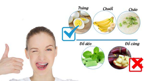 thực phẩm cần tránh khi niềng răng