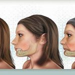 Có cần thiết phải nhổ răng khôn xong nhập viện hay không?