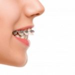 Gợi ý bữa sáng cho người niềng răng nên tham khảo