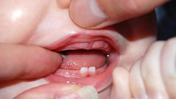 Trẻ em mọc răng không theo thứ tự có sao không?