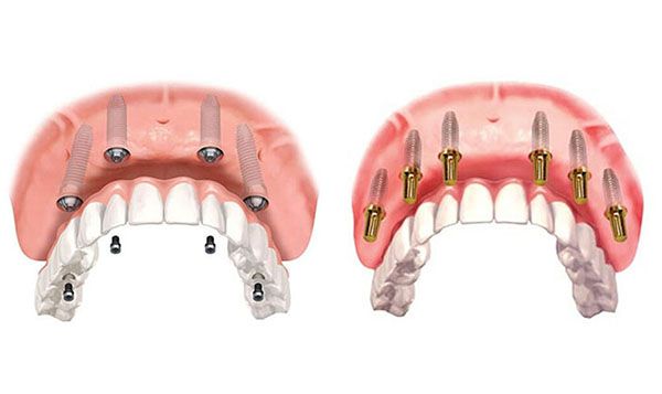 Trồng răng implant giá bao nhiêu?