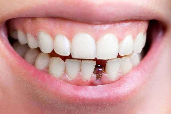 Cấy ghép implant có đau không