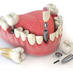 Cấy ghép răng implant có đau không?
