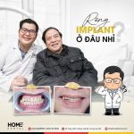Trụ Implant Dentium Mỹ: Cấu tạo và ưu điểm nổi bật
