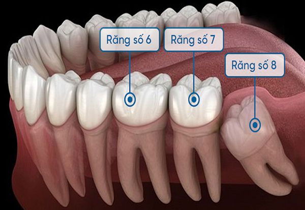 Nhổ răng số 7 bao lâu thì trồng lại được?