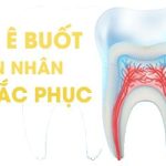 Nhổ răng số 7 bao lâu thì trồng lại được?