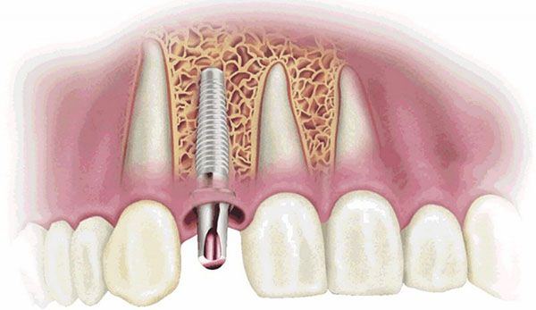 Trụ implant bị đào thải do không chăm sóc đúng cách