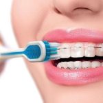 Bỏ niềng răng giữa chừng để lại hậu quả nghiêm trọng không?