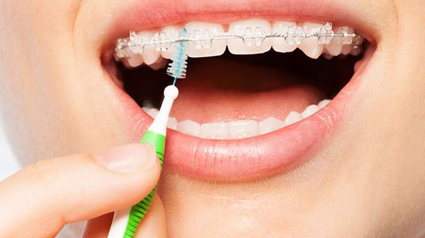 Bàn chải kẽ răng cho người niềng