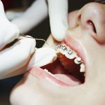 Gợi ý bữa sáng cho người niềng răng nên tham khảo