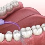 Bọc răng sứ có bị hôi miệng không?
