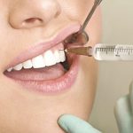 Trồng răng implant gây mê được không?