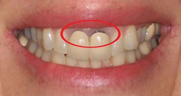 Dấu hiệu bọc răng sứ bị hở chân răng