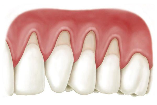 Hở cổ chân răng hậu quả bọc răng sứ