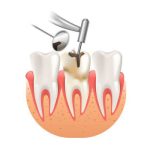 Bị sâu răng nhẹ đánh răng có hết được không?