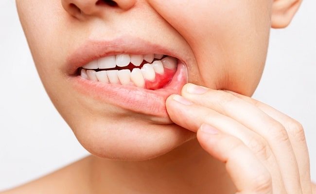 Đái tháo đường có bị viêm nha chu không?