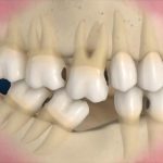 Bị mất răng số 6 có niềng răng được không?