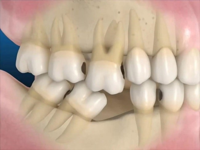 Mất răng số 7 có niềng răng được không?