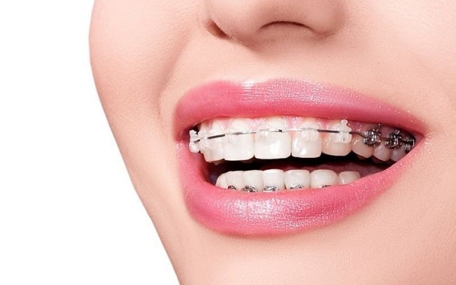Niềng răng có phải nhổ răng khểnh không?